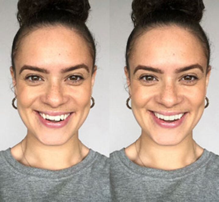 Invisalign System - Before and After