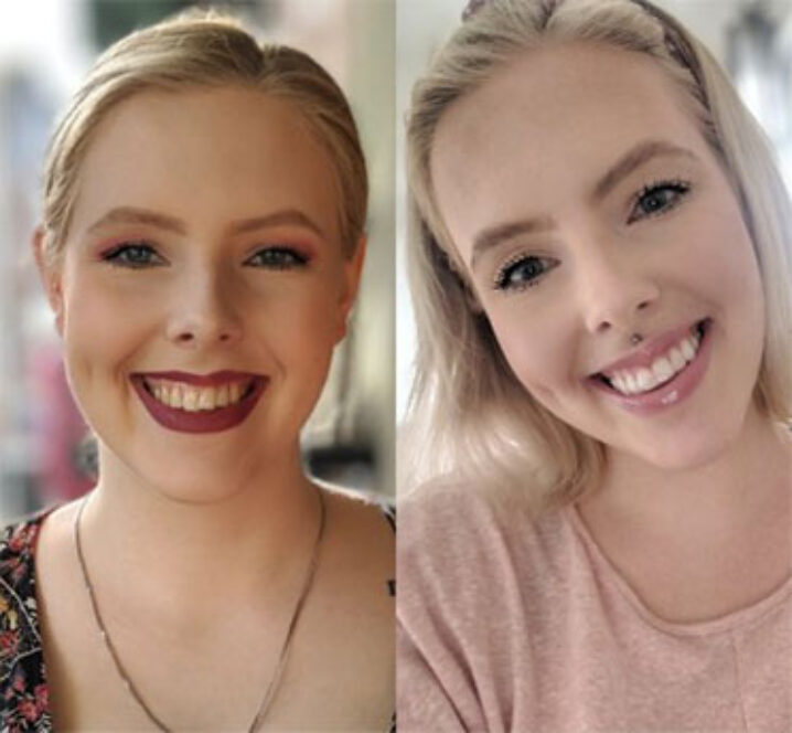 Invisalign Aligners - Before and After