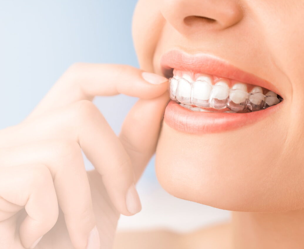 Invisalign Braces in Derby