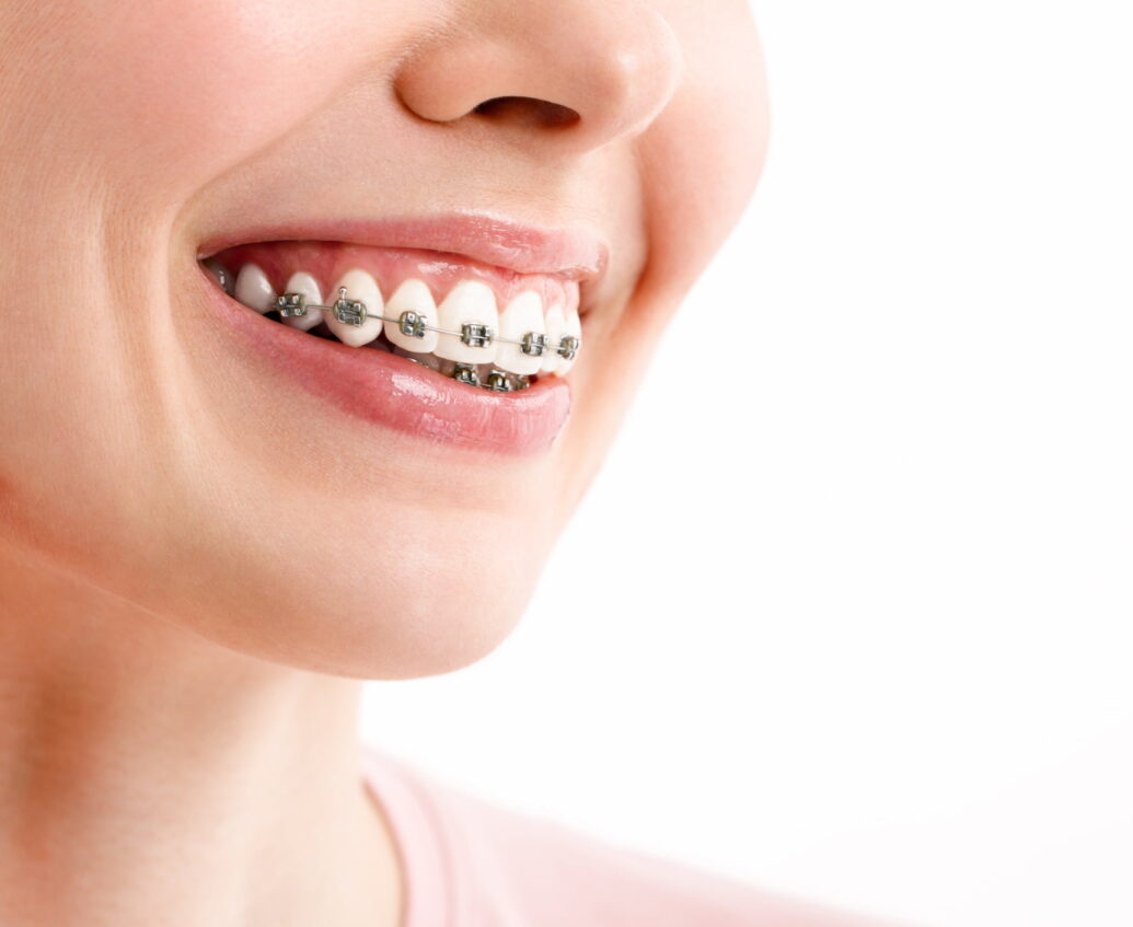 Traditional metal wired braces