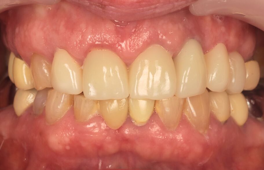 After - Ashbourneroad Dental