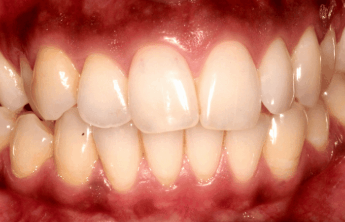 Before - dentblanche