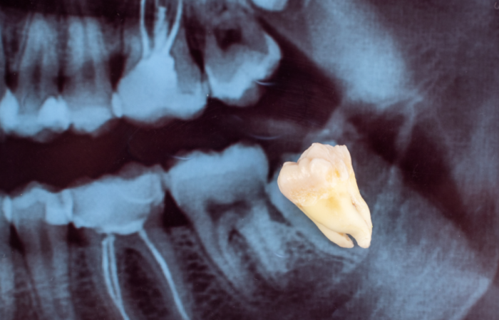 Close up of a wisdom tooth X-ray.