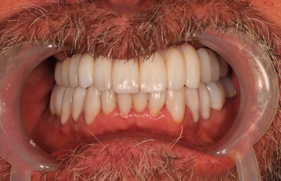 After - Ashbourneroad Dental