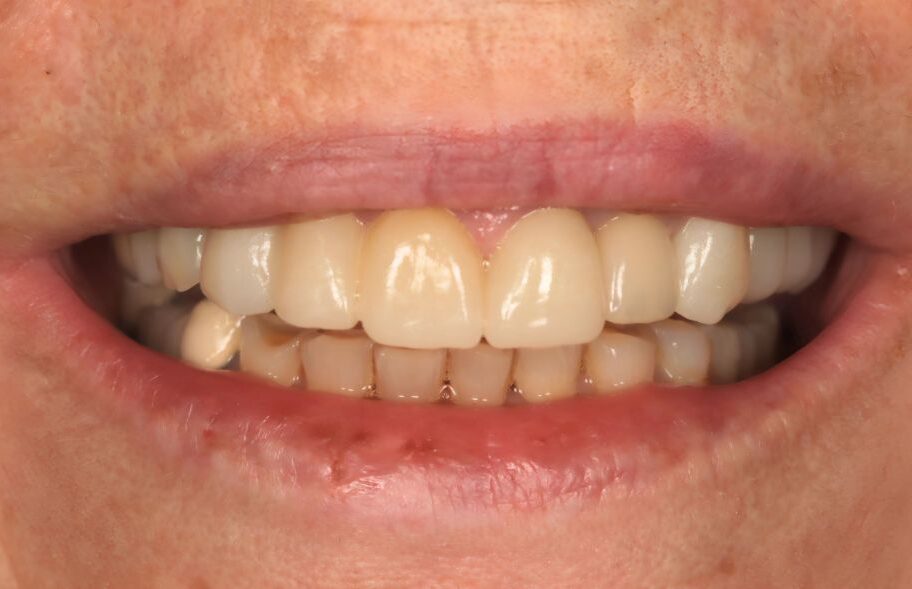 After - Ashbourneroad Dental