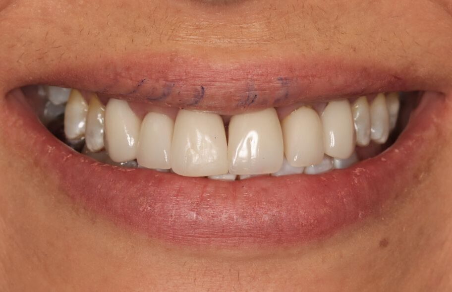 Before - Dentblanche