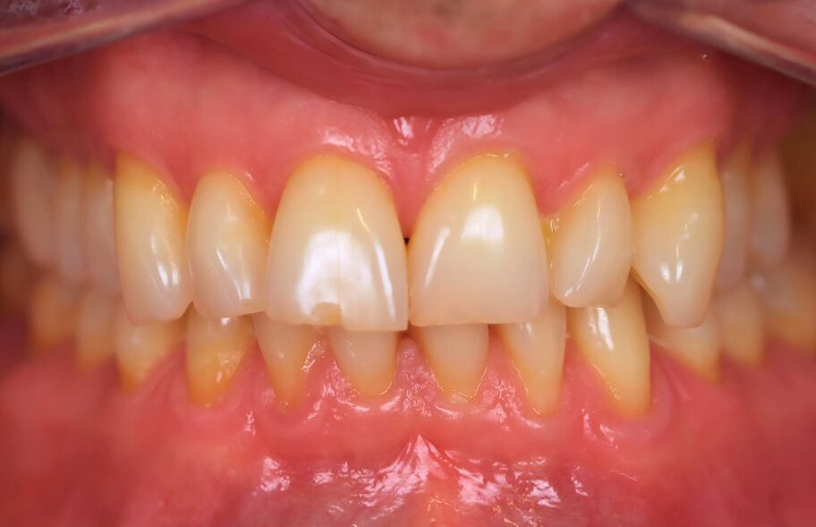 Before - Dentblanche