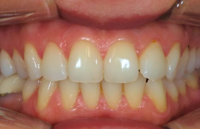 Before - dentblanche