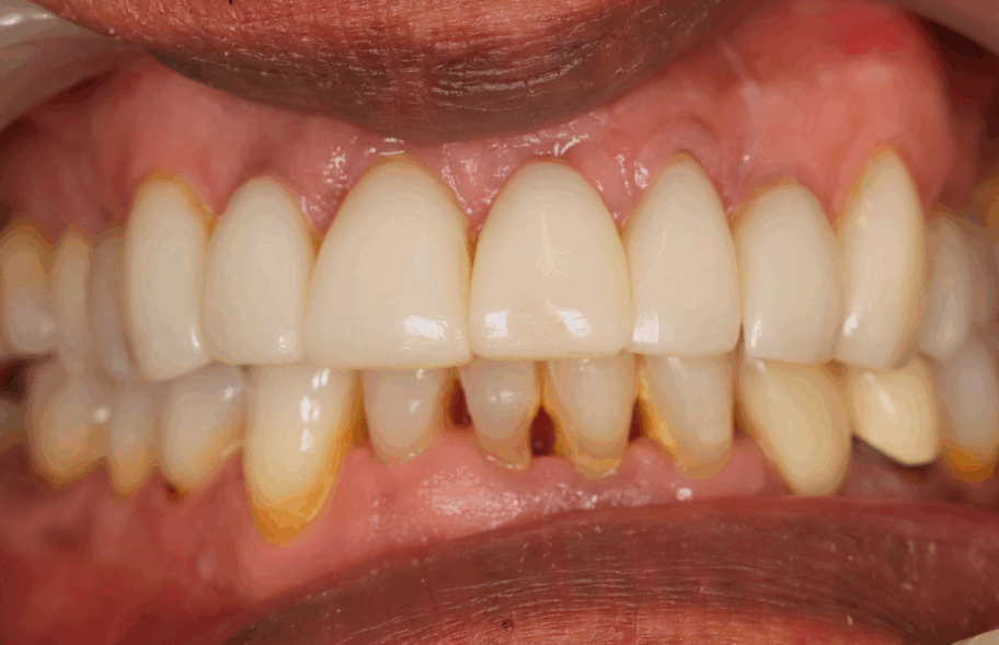 Before - Dentblanche