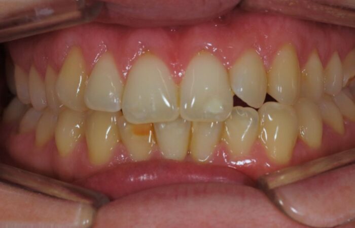 Before - dentblanche